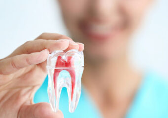 Root Canal Therapy(RCT)